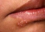 herpes-lips