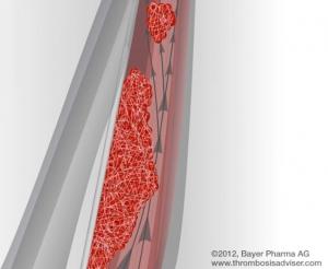TEV et embolie pulmonaire: La FDA approuve le nouvel anticoagulant Xarelto®  – FDA