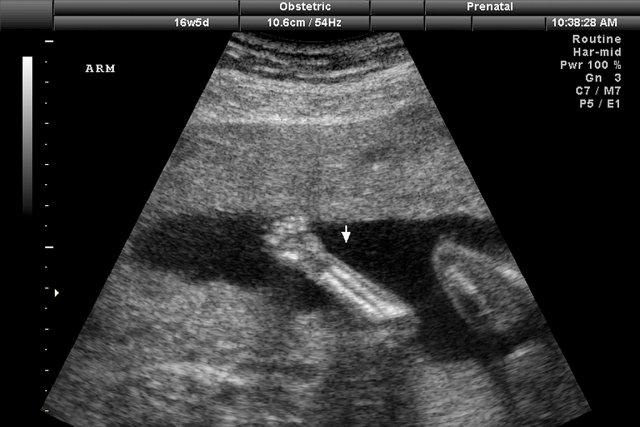 Génomique du placenta 101 Le placenta est un organe temporaire essentiel à la poursuite de la grossesse... (Photothèque La Presse)