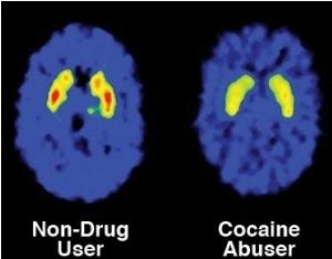 COCAÏNE: Le risque de dépendance se lit dans le cerveau – Biological Psychiatry