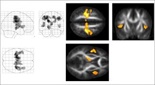 Oligonucléotide antisens contre SOD-1 administré par voie intraspinale chez des patients atteints de sclérose latérale amyotrophique SOD-1 : une étude randomisée de phase 1/première étude chez l’humain Oligonucléotide antisens contre SOD-1 administré par voie intraspinale chez des patients atteints de sclérose latérale amyotrophique SOD-1 : une étude randomisée de phase 1/première étude chez l’humain