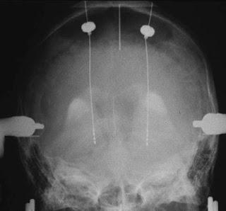 Changements dans les critères de recherche pour le diagnostic de la maladie de Parkinson: obstacles et opportunités Changements dans les critères de recherche pour le diagnostic de la maladie de Parkinson: obstacles et opportunités