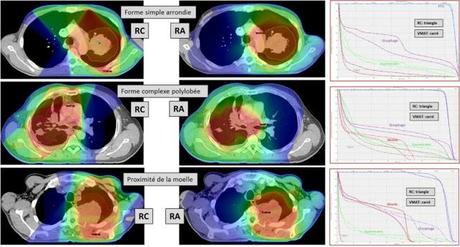 Critères de substitution pour l’évaluation de la survie lors des essais de chimiothérapie et radiothérapie dans le cancer du poumon opérable et localement avancé: nouvelle analyse de méta-analyses de données individuelles de patients