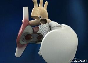 Un coeur artificiel - Carmat