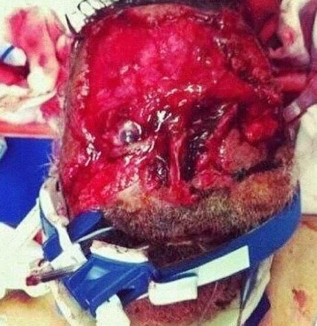 RONALD POPPO UN AN PLUS TARD : LA VICTIME DU CANNIBALE DE MIAMI SE REMET DE SES OPERATIONS CHIRURGICALES Ronald Poppo - CAS DE CANNIBALISME : UN HOMME DEVORE LE VISAGE D'UN AUTRE HOMME ET SA VICTIME MONTE UNE FONDATION POUR PAYER SES OPERATIONS DE CHIRURGIE (Ronald Poppo foundation)