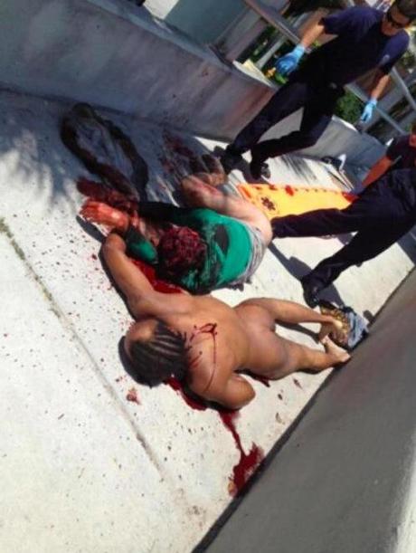 RONALD POPPO UN AN PLUS TARD : LA VICTIME DU CANNIBALE DE MIAMI SE REMET DE SES OPERATIONS CHIRURGICALES Ronald Poppo - CAS DE CANNIBALISME : UN HOMME DEVORE LE VISAGE D'UN AUTRE HOMME ET SA VICTIME MONTE UNE FONDATION POUR PAYER SES OPERATIONS DE CHIRURGIE (Ronald Poppo foundation)