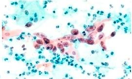 CANCER du COL: Un coton-tige et du vinaigre pour le dépister – ASCO CANCER du COL: Un coton-tige et du vinaigre pour le dépister – ASCO