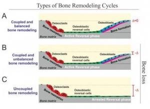 OSTÉOPOROSE: Une nouvelle cible identifiée pour réparer l'os – American Journal of Pathology