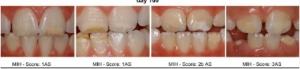 BISPHÉNOL A: Il déminéralise l'émail des dents des enfants – American Journal of Pathology