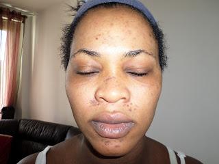 voici les dégats que peuvent faire les produits à base d'hydroquinone voici les dégats que peuvent faire les produits à base d'hydroquinone