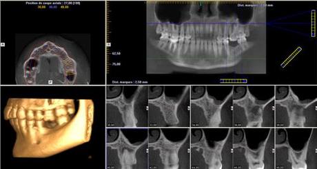 Cas clinique de couronne sur pilier implantaire CFAO (système Ti-Base de Sirona)