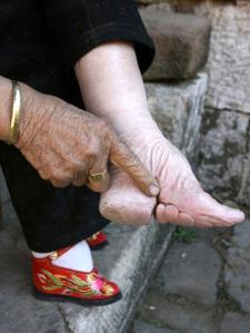 Photo de pieds bandés après plusieurs années de bandages