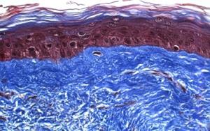 ULCÈRES CUTANÉS: Un pansement en peau humaine pour les ulcères réfractaires – Advances in Skin and Wound Care
