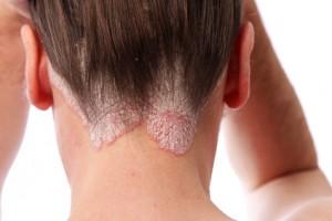 Schuppenpflechte-Psoriasis am Haaransatz und auf der kopfhaut