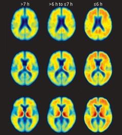 Le manque de SOMMEIL associé au risque d'Alzheimer – JAMA Neurology