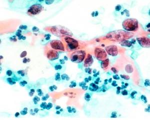 VACCIN anti-HPV: 1 seule dose pourrait suffire – Cancer Prevention Research