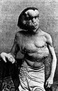 #1 La biologie c’est fantastique : le blobfish, c’est pas si horrible ElephanMan ou Joseph Merreck était bien malade...
