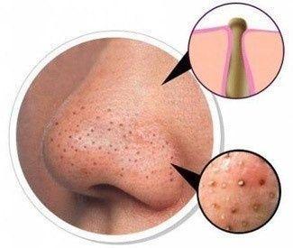 Les boutons dans de différentes zones de la personne