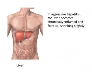Hep’ 2014 ? Cmaintenant… – SOS Hépatites Hep’ 2014 ? Cmaintenant… – SOS Hépatites