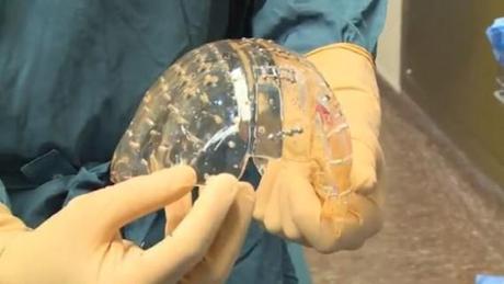 chirurgien néerlandais crâne en plastique