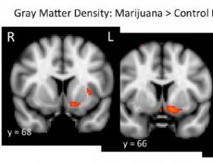 CANNABIS: Il altère la structure du centre de récompense du cerveau – The Journal of Neuroscience