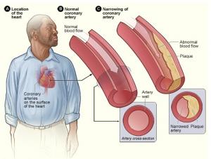 STRESS: Il induit jusqu'à des lésions cardiaques – Nature Medicine