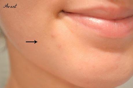 Comment traiter et faire disparaître les imperfections ? Comment traiter et faire disparaître les imperfections ?