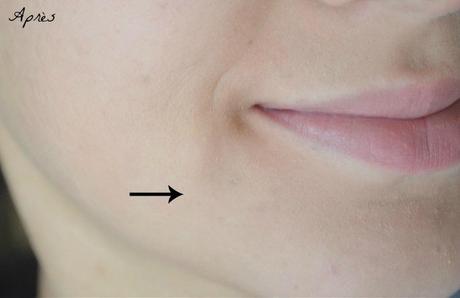 Comment traiter et faire disparaître les imperfections ? Comment traiter et faire disparaître les imperfections ?