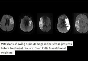AVC: La thérapie par cellules souches confirme ses promesses – Stem Cells Translational Medicine