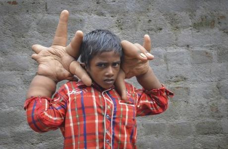 Mohammad Kaleem, le garçon aux mains difformes