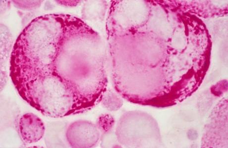 Combinaison de cediranib et d’olaparib versus olaparib seul chez des femmes atteintes de cancer de l’ovaire récidivant sensible au platine : étude de phase 2 randomisée
