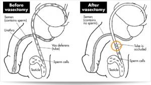 CONTRACEPTION MASCULINE: Vasalgel, pour une vasectomie, oui mais provisoire – Parsemus Foundation
