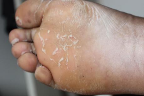 Faire peau neuve avec Baby Foot Faire peau neuve avec Baby Foot