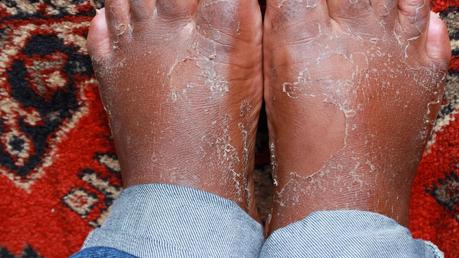 Faire peau neuve avec Baby Foot Faire peau neuve avec Baby Foot