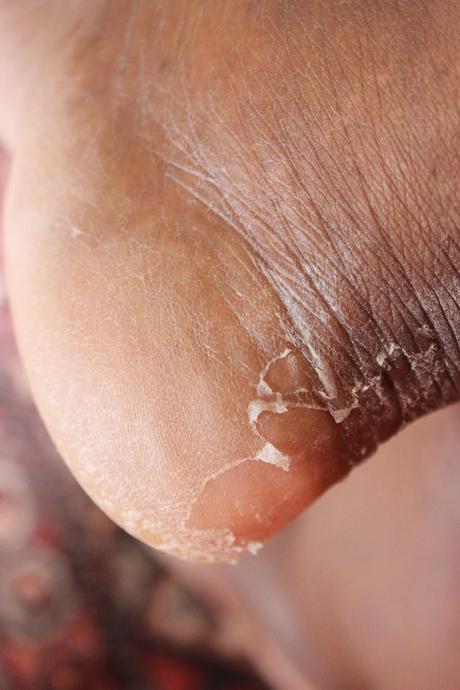 Faire peau neuve avec Baby Foot Faire peau neuve avec Baby Foot