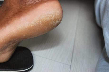 Faire peau neuve avec Baby Foot Faire peau neuve avec Baby Foot