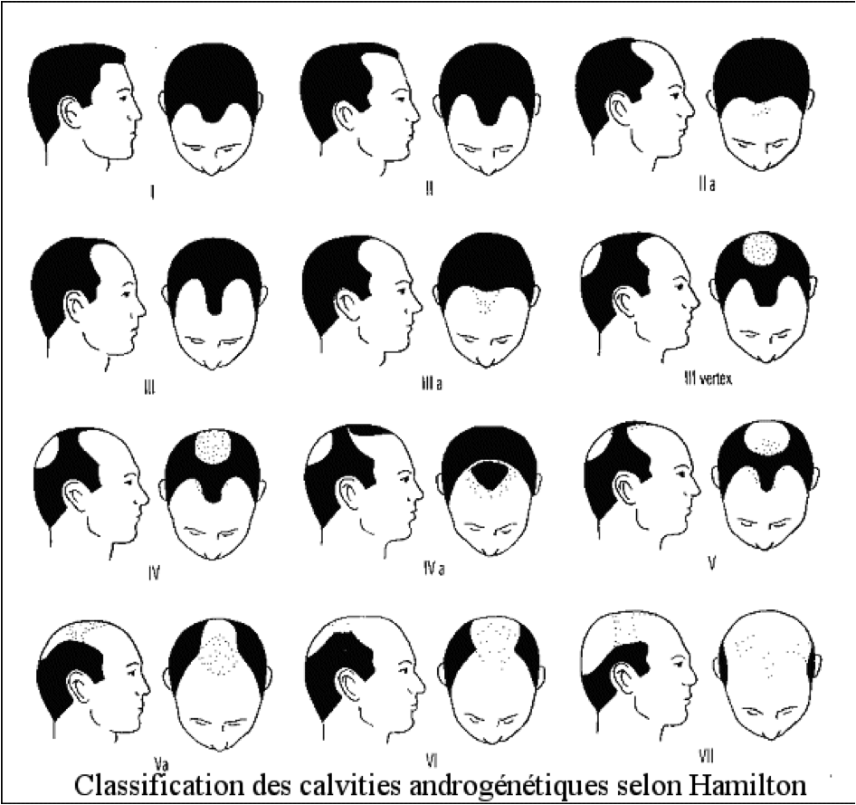 La greffe de cheveux sans chirurgie Greffes des cheveux