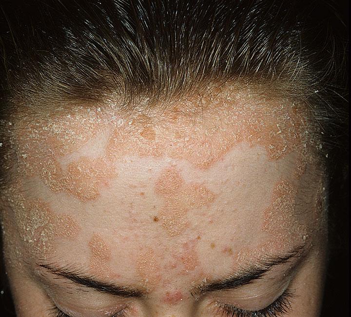 Diffusif atopitchesky la dermatite chez les adultes