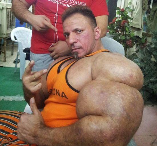 Synthol muscles horrible