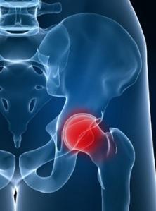 PRÉMATURITÉ: Le faible poids de naissance induit une fragilité des hanches – Arthritis Care & Research