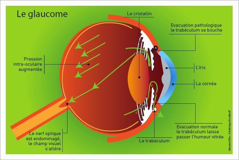 #latanoprost #glaucome Latanoprost pour le glaucome à angle ouvert (UKGTS) : étude multicentrique, randomisée et contrôlée par placebo