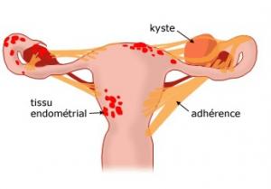 ENDOMÉTRIOSE : Semaine européenne de prévention et d’information, 3 au 9 mars 2015 – EndoFrance VISUEL ENDODIAG