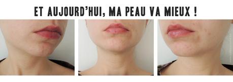 Les résultats Mon histoire d'acné #7 ♥ Nouvelle routine