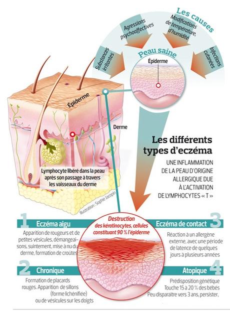 Eczéma, dermatite atopique eczema