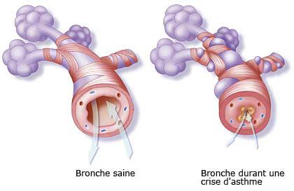 Asthme, généralités et conseils asthme