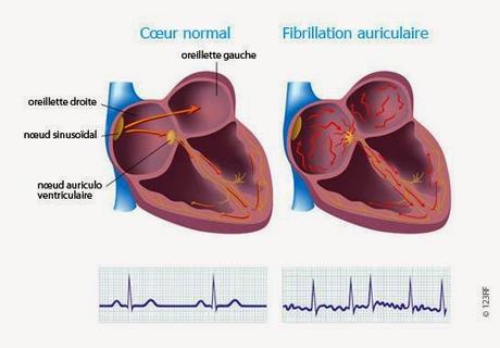 #thelancet #fibrillationauriculaire #insuffisancecardiaque #digoxine #rivaroxaban Administration de Digoxine chez des patients atteints de fibrillation auriculaire et séquelles cardiovasculaires : analyse rétrospective de l’effet de la prise monoquotid...