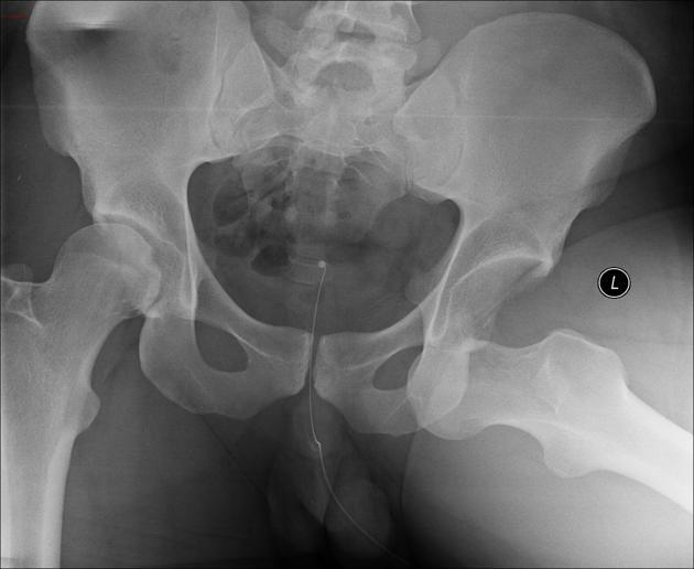 Image N°2 : luxation antérieure obturatrice de la hanche hanche dislocation