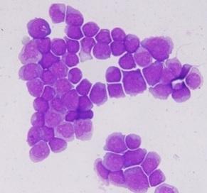 LEUCÉMIE: Des mutations de prédisposition inévitables avec l'âge  – Cell Reports