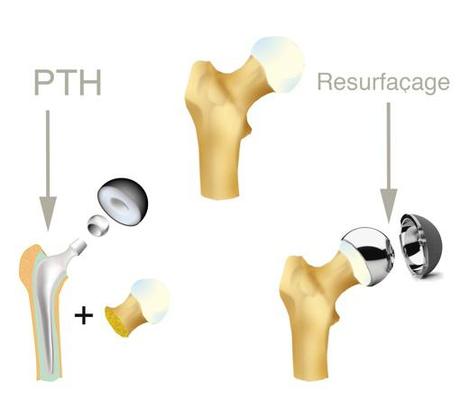 Technique d’implantation d’une prothèse totale de hanche de resurfaçage resurfacage_PTH