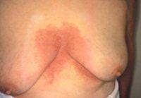La curcumine du Curcuma contre la Candida zone-mammaire-candida
